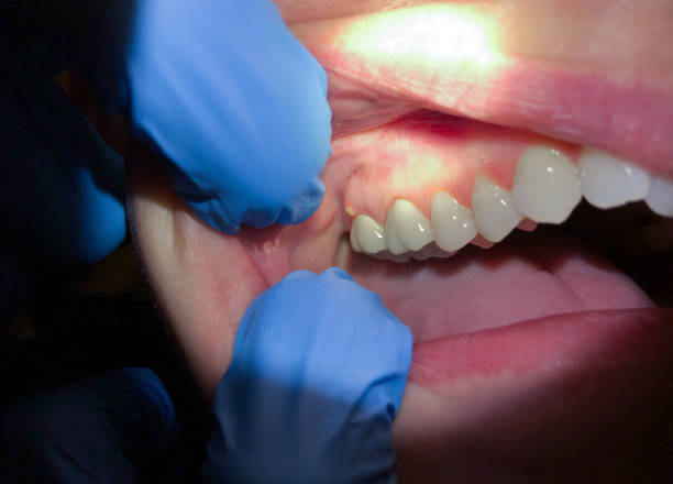 Best Emergency Dental Care for Abscessed Tooth in Seminole, OK